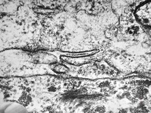 M,7m. | a formation of Birbeck granule(Langerhans granule, X-granule) - skin, histiocytosis X